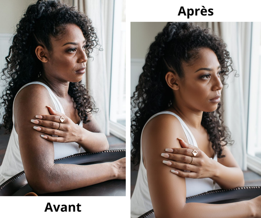 Pommade Antibactérienne - Eczéma