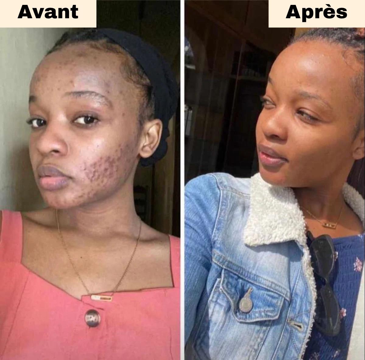 GlowCurcuma : zéro bouton, zéro tache en 30 jours