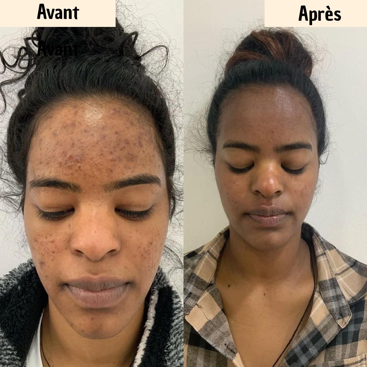 GlowCurcuma : zéro bouton, zéro tache en 30 jours