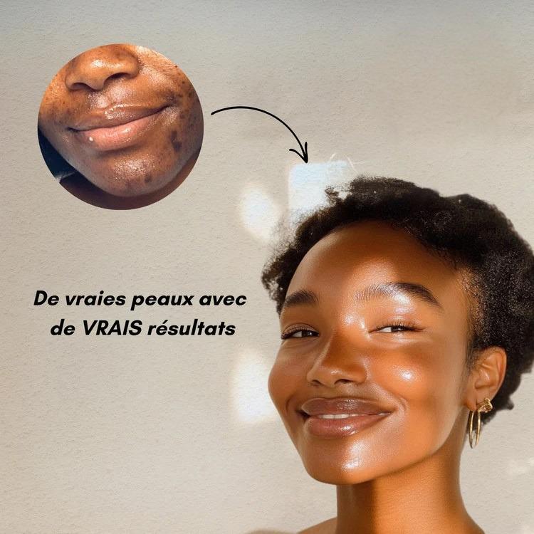 GlowCurcuma : zéro bouton, zéro tache en 30 jours