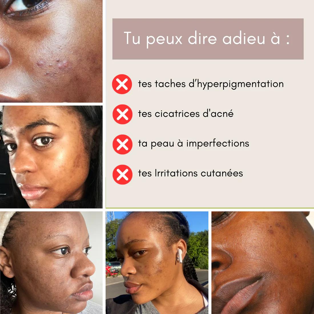 GlowCurcuma : zéro bouton, zéro tache en 30 jours
