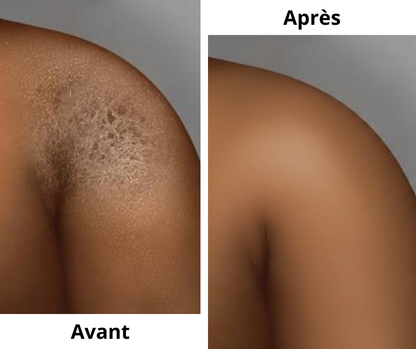 Pommade Antibactérienne - Eczéma