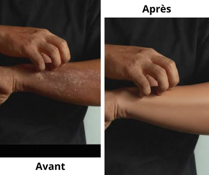 Pommade Antibactérienne - Eczéma