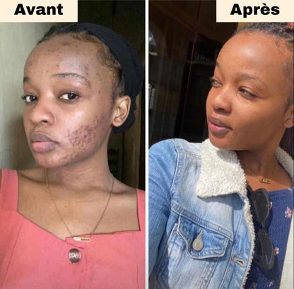 GlowCurcuma : zéro bouton, zéro tache en 30 jours